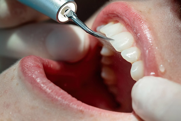 Cada cuanto tiempo hacerse una limpieza dental